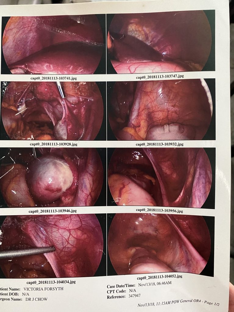 Tori Forsyth - Results of endo removal